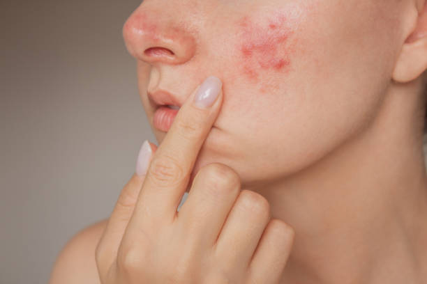 Close-up of a person touching their cheek showing signs of acne