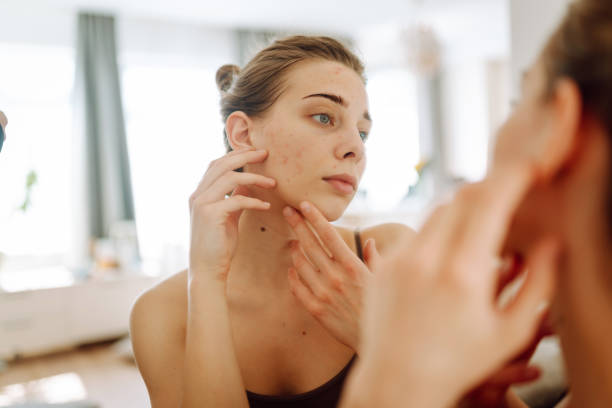 Teenage girl examining acne in mirror