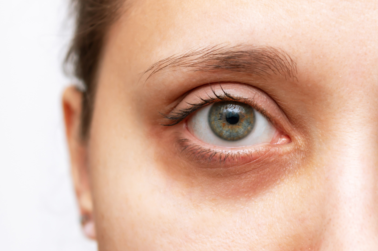 Natural ways to improve sunken eyes appearance and look more refreshed