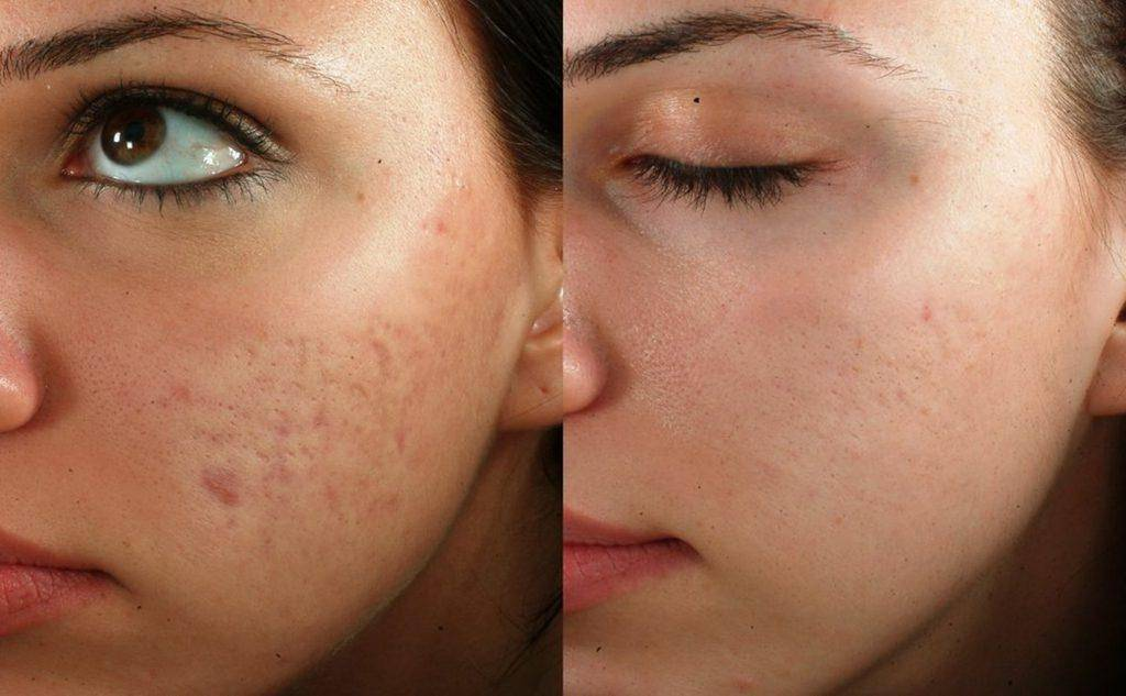 Before-and-after comparison of microneedling treatment for acne scars, demonstrating long-lasting effects