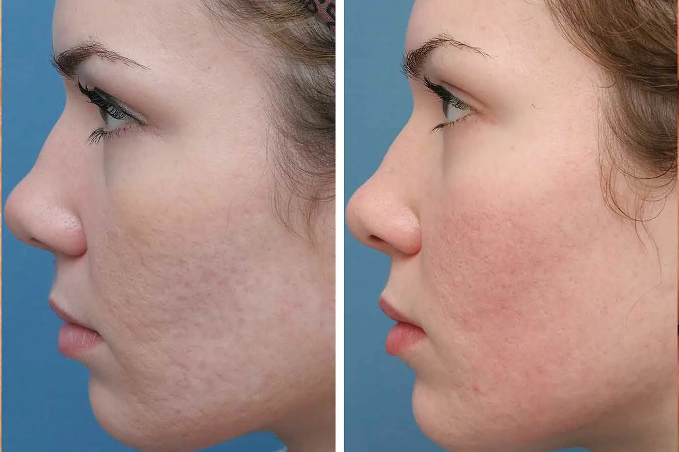 Professional microneedling procedure for treating acne scars, producing lasting improvements